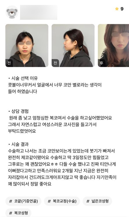 Rhinoplasty Review. "I’m really happy because I’m much more satisfied with my appearance!" image 1