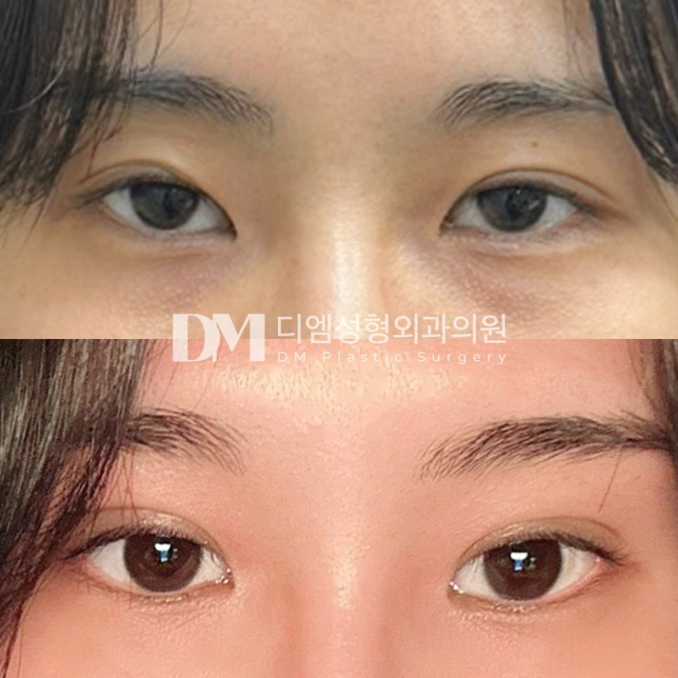 Review of Revision Eyelid Surgery: “I’m very happy that my eyes are now defined and won’t become loose again!” image 2