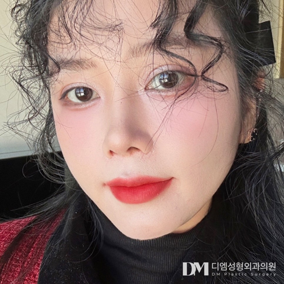 얼굴지방이식, 꺼진 부위에 볼륨과 생기를 관련 이미지 9