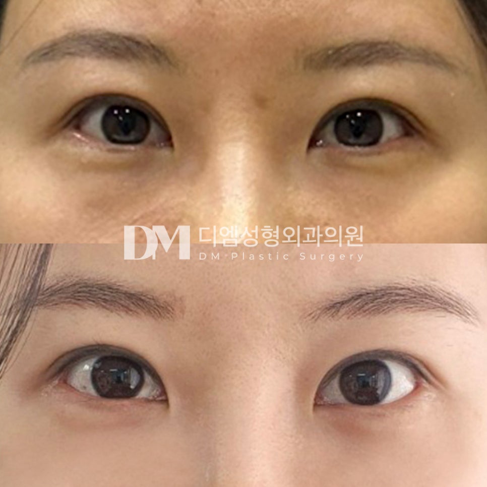 Under-Eye Fat Repositioning Review: “I’m so happy and satisfied that my under-eyes no longer look tired~~!!” image 2