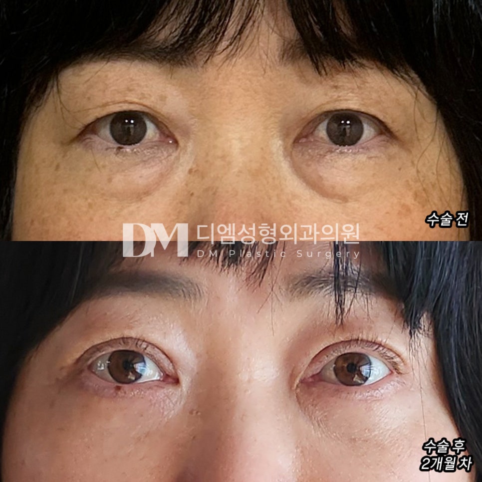 중년 눈성형 후기."엄마가 너무 만족해하셔서 제가 다 뿌듯해요!" 관련 이미지 2