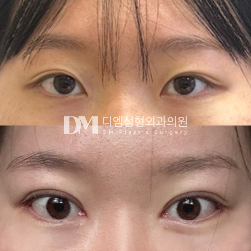 눈성형 후기."서서히 자리잡는 중이에요!" 관련 이미지 2