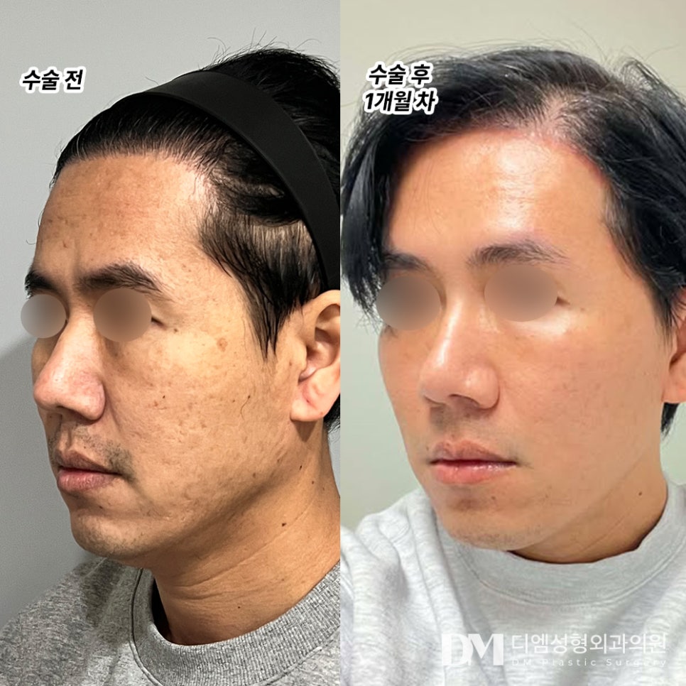 Partial facelift, naturally and without overdoing it! image 7