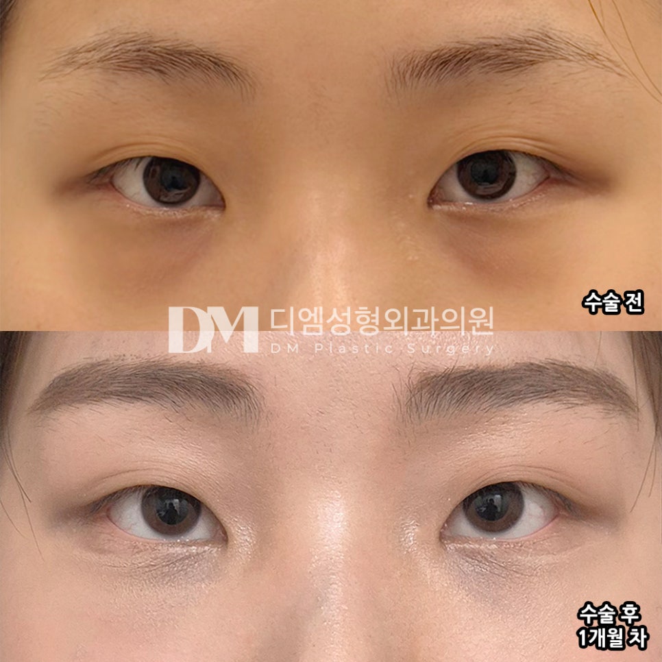 DM Under-Eye Fat Repositioning Surgery Review, “Even if I could go back, I think I would have the surgery without hesitation!” image 2