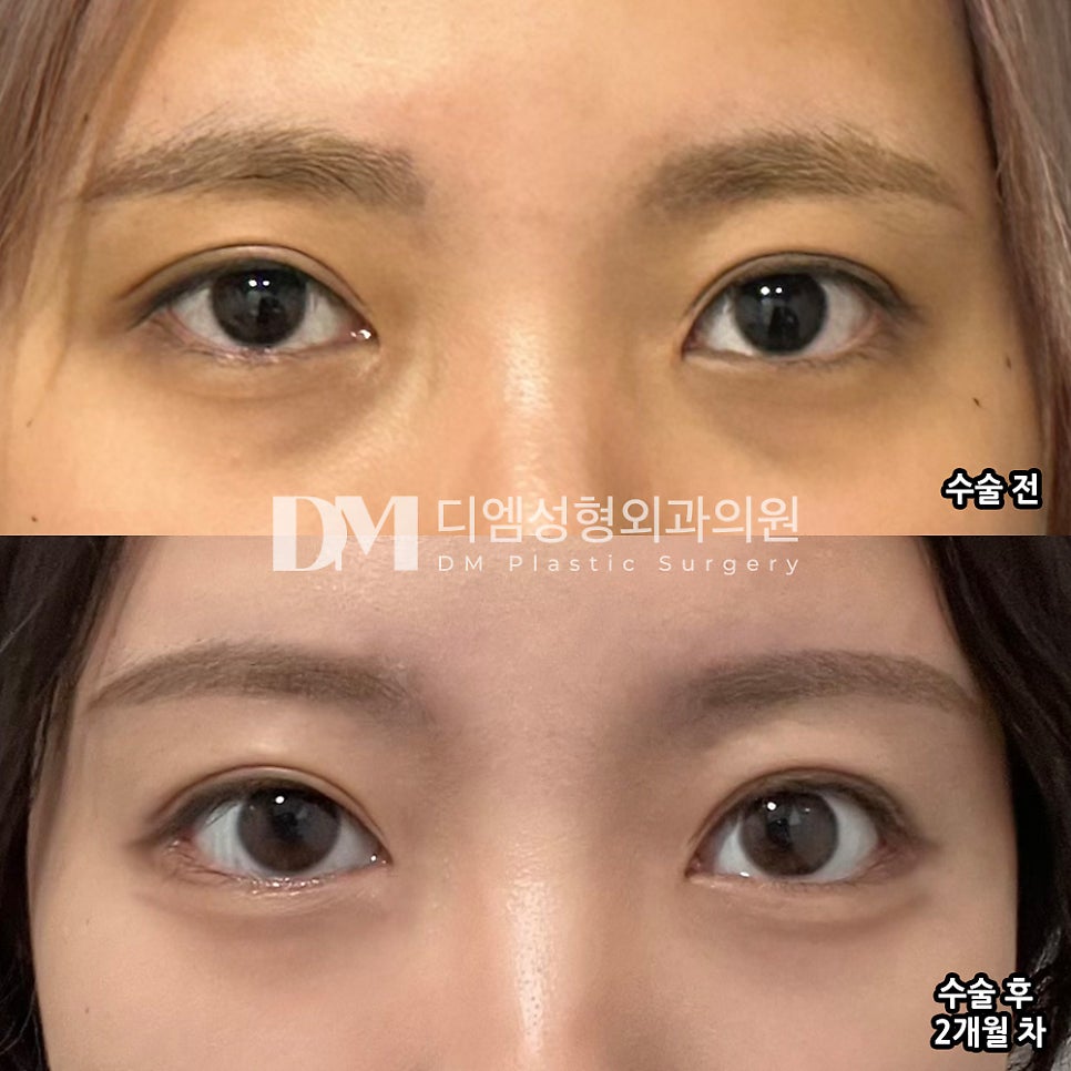 Blepharoplasty Review. “I’m satisfied that the overall change in my face feels brighter without being too dramatic!” image 2
