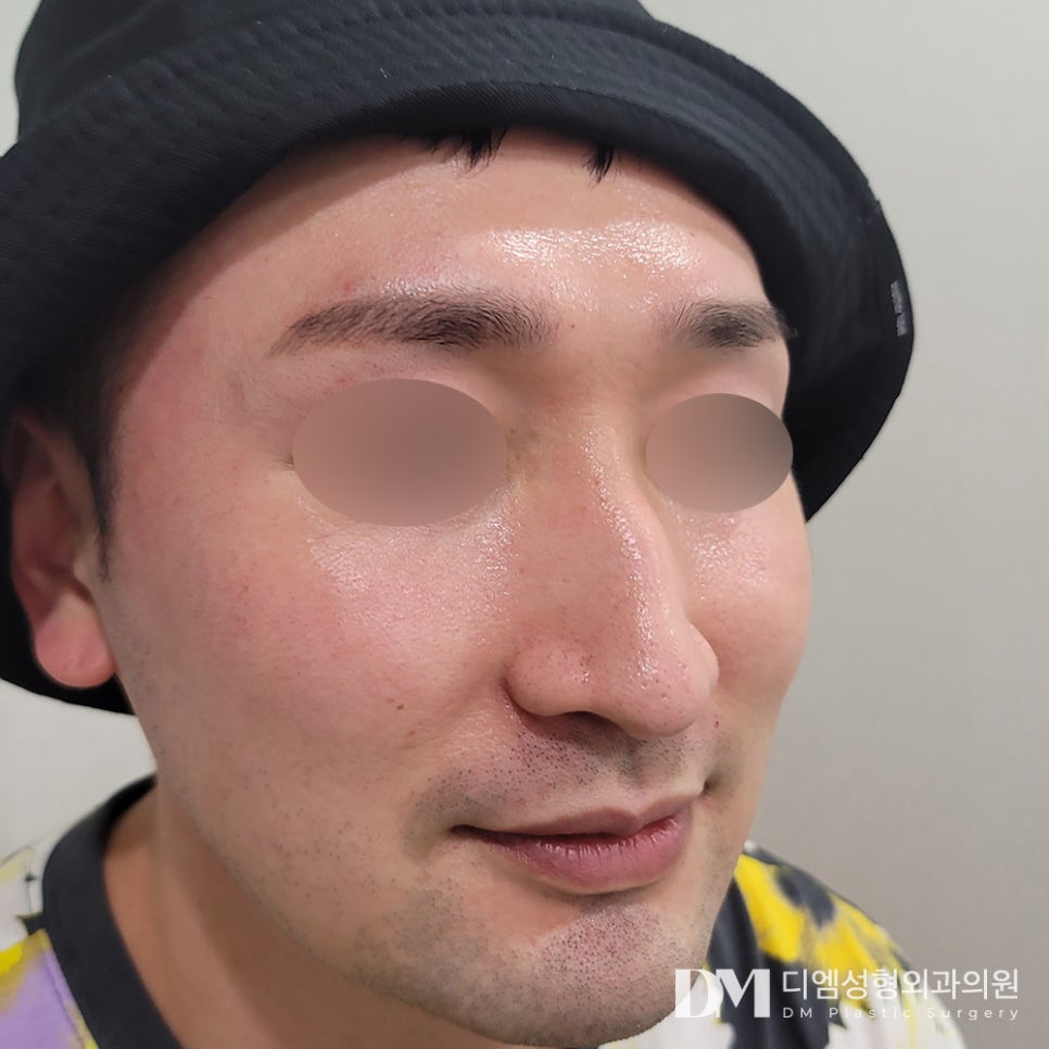 긴코,화살코 성형 코가 길고 끝이 처져 스트레스라면? 관련 이미지 6