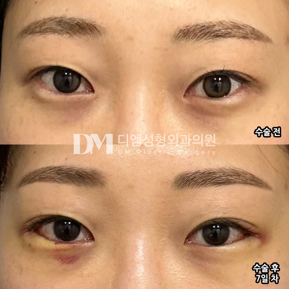 Lower Outer Canthoplasty Review. "Overall, I’m very satisfied!" image 2