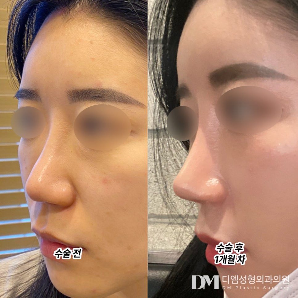 Rhinoplasty Review. "I feel delighted thinking about my nose becoming even prettier!" image 2