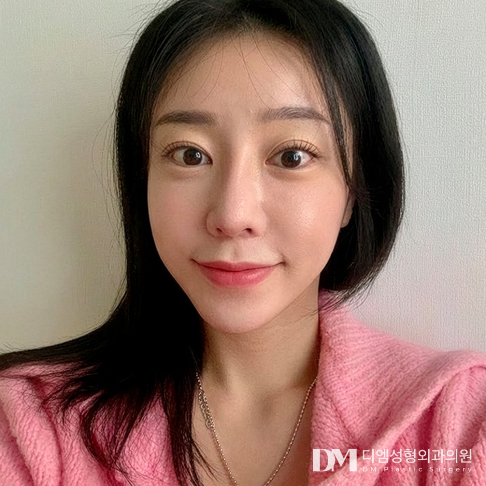 디엠 반거상 전후사진, 깊은 팔자주름이 고민이라면? 관련 이미지 1