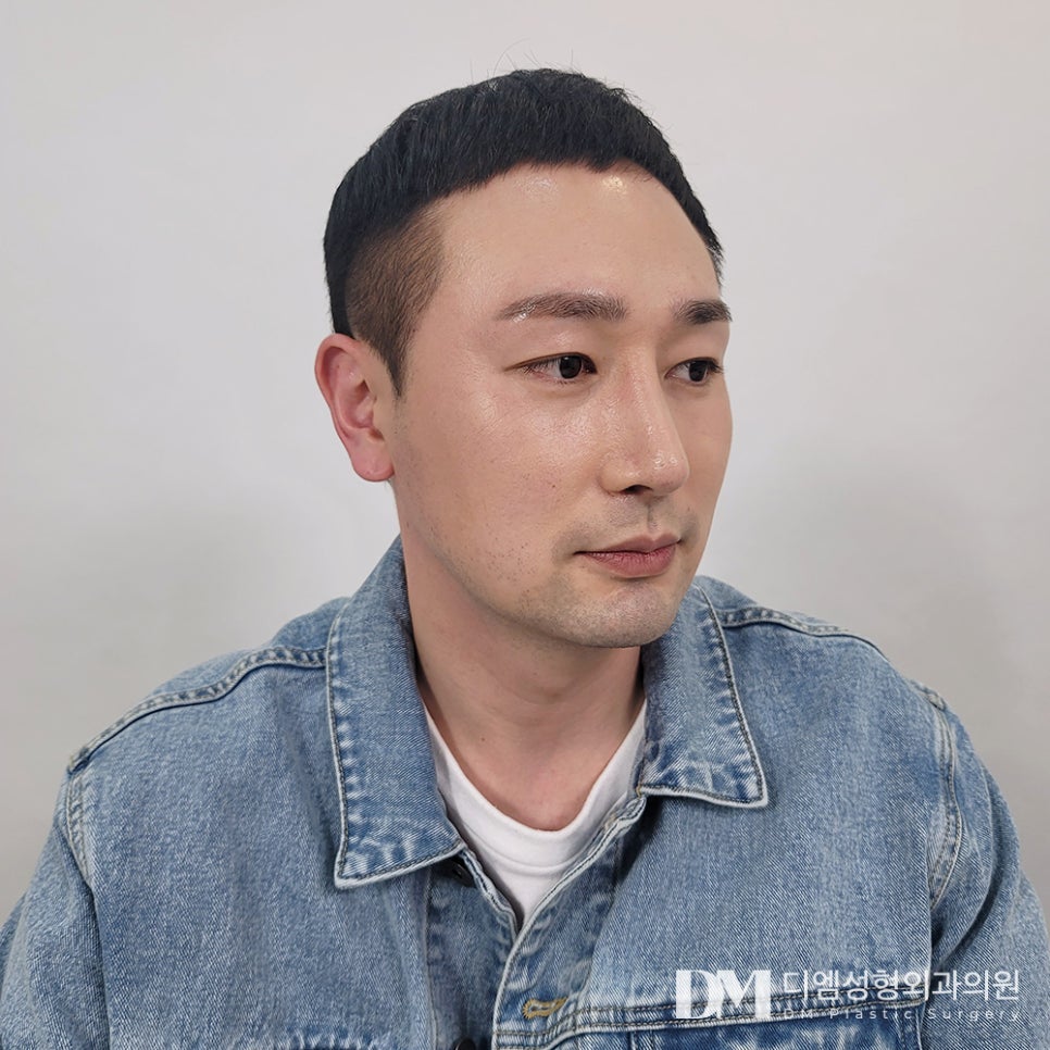 얼굴전체의 비율을 고려해 짧은 코 완벽 교정하기 관련 이미지 1