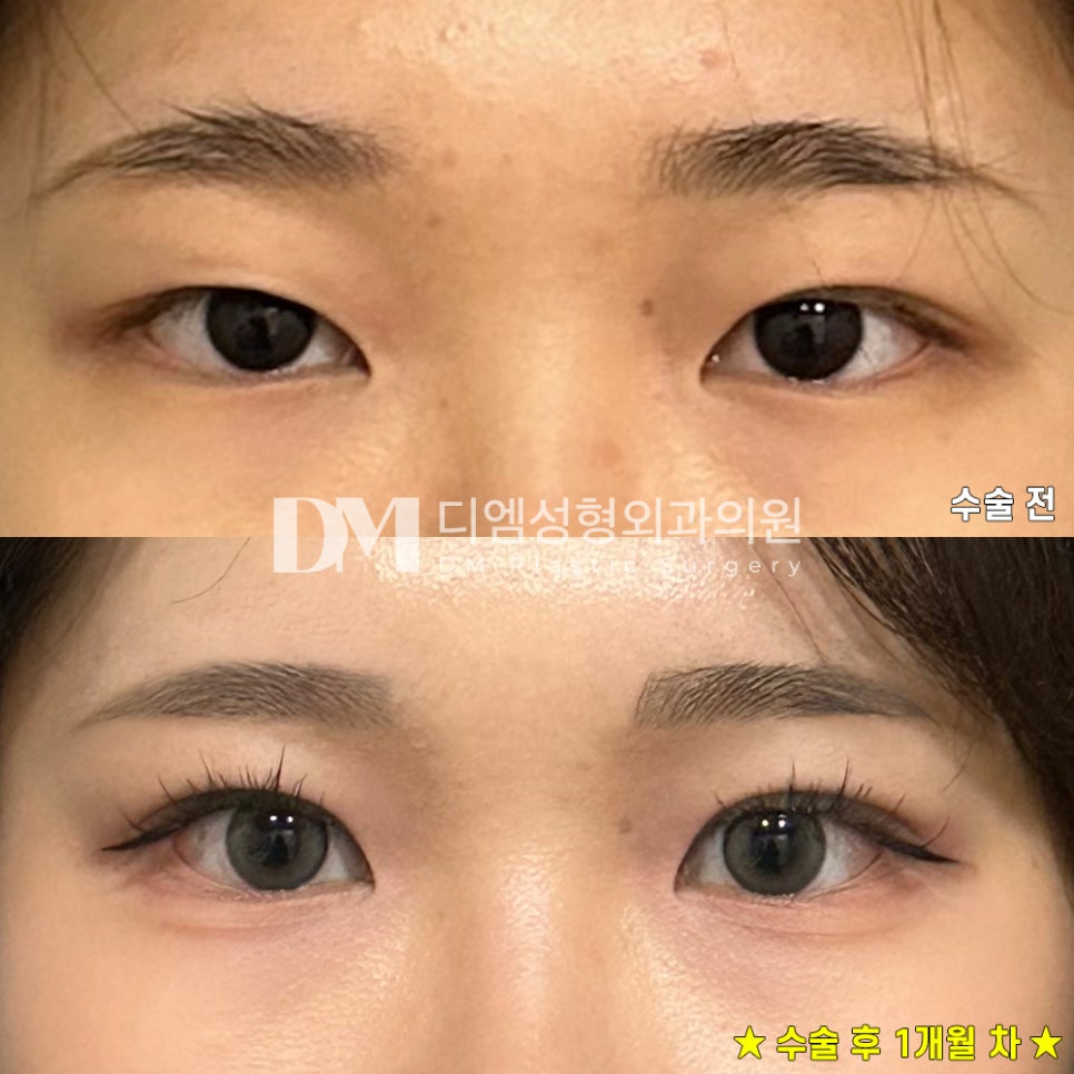 눈재수술, 쌍꺼풀이 풀려 비대칭 눈매가 되었다면? 관련 이미지 8