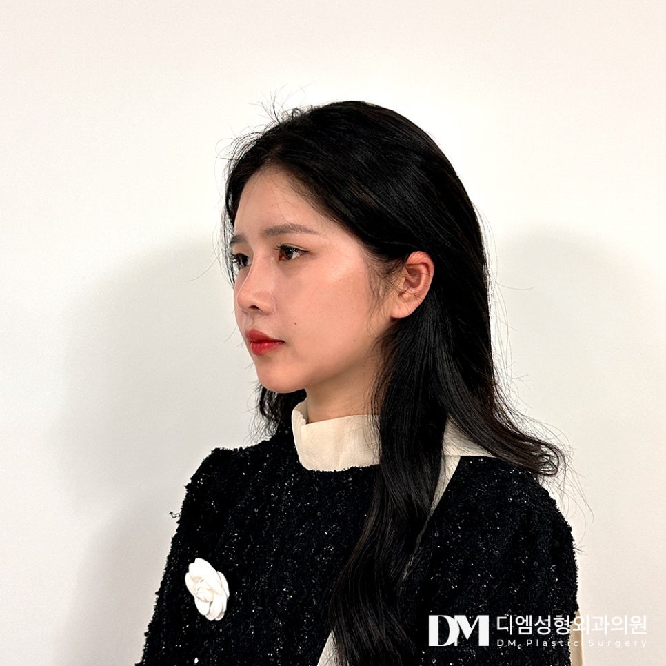 반거상, 안면거상은 부담스러웠다면 주목! 관련 이미지 14