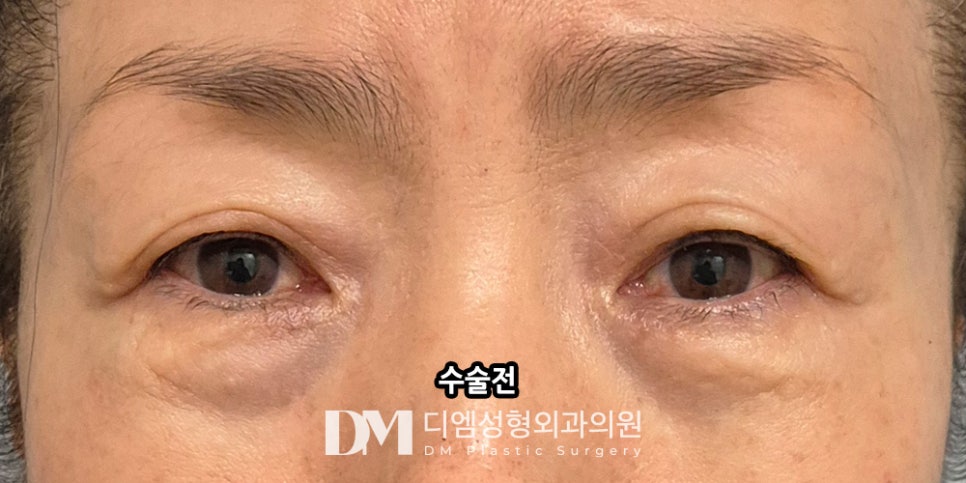 Lower Blepharoplasty: Improve Under-Eye Aging for a More Youthful Look! image 7