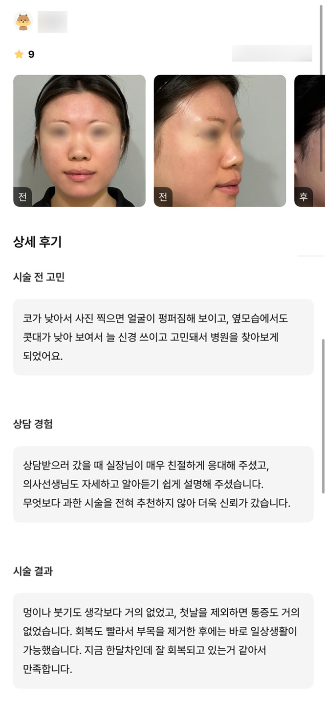 코성형 후기."회복도 잘 되고 있어 만족합니다!" 관련 이미지 1