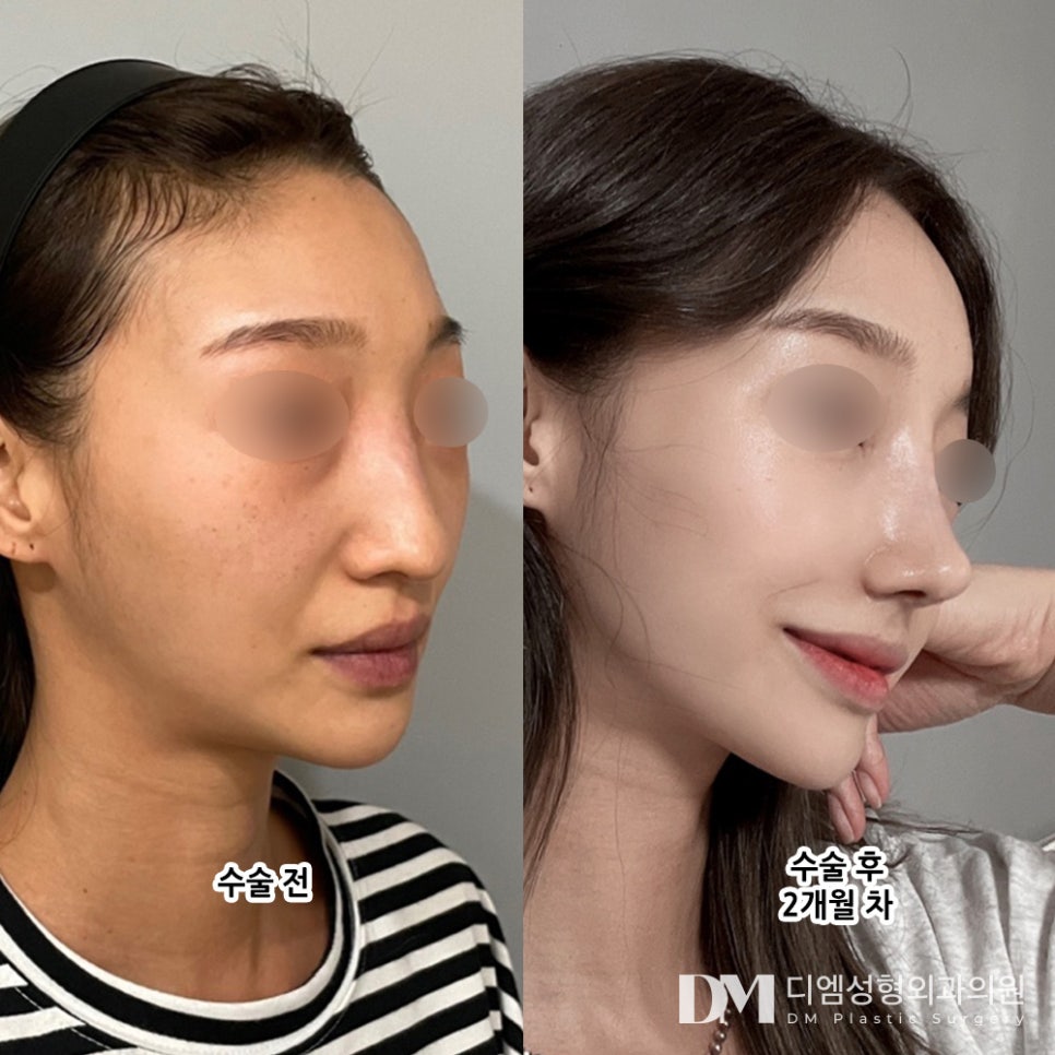 긴코성형, 개선하니 어려보이는 동안 이미지로? 관련 이미지 6