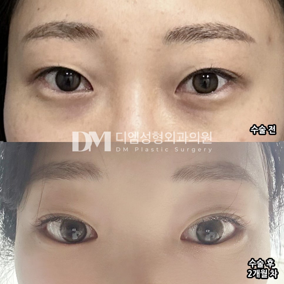 뒤밑트임 후기."눈이 훨씬 시원하고 또렷해 보이는게 가장 만족스러워요!" 관련 이미지 2