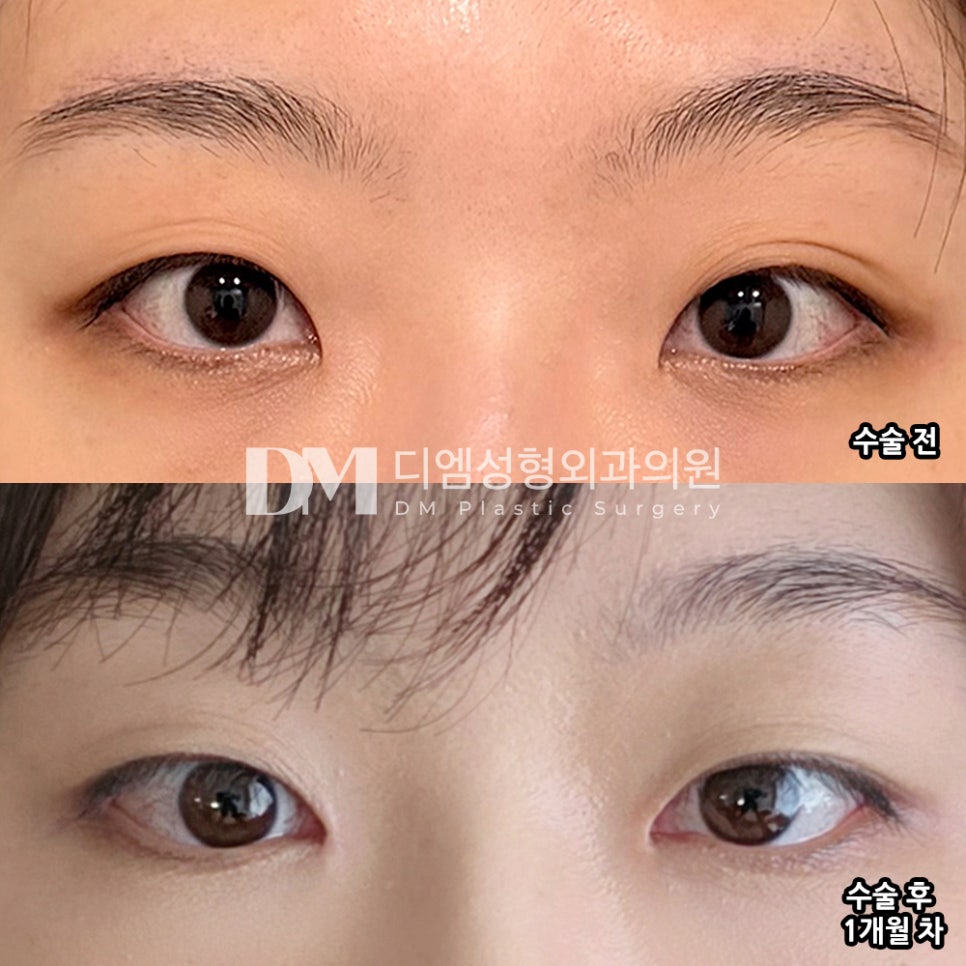 디엠 앞트임 수술후기, “자연스럽게 자리 잡아서 더 만족하고 있어요!” 관련 이미지 2