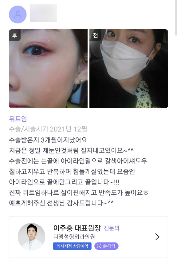 빵트임 후기."뒤트임 하나로 삶이 편해지고 만족도가 높아요!" 관련 이미지 1