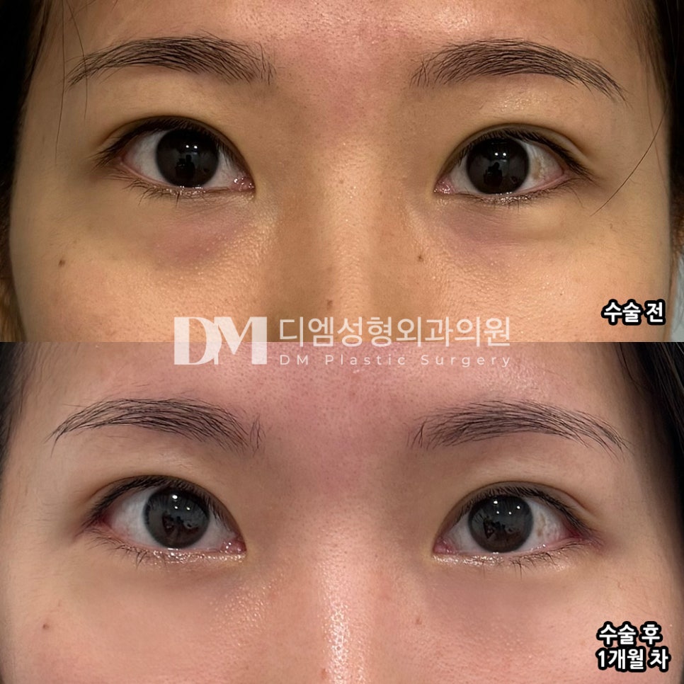 Improving Uneven Under-Eye Contours That Ruin Your Impression with Under-Eye Fat Repositioning image 6