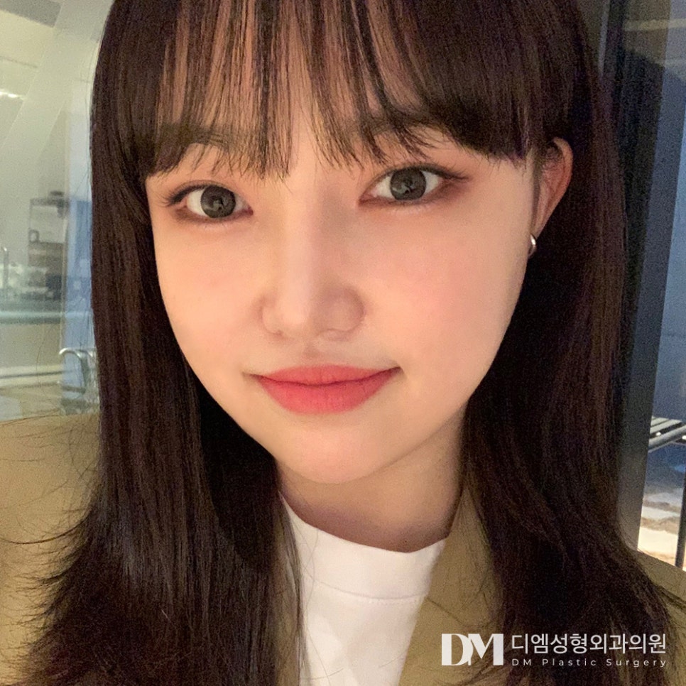 Double Eyelid Surgery: A Customized Line That Suits My Eyes image 1
