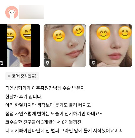 코성형 후기."점점 자연스럽게 변하는 모습이 신기하기만 하네요~" 관련 이미지 1