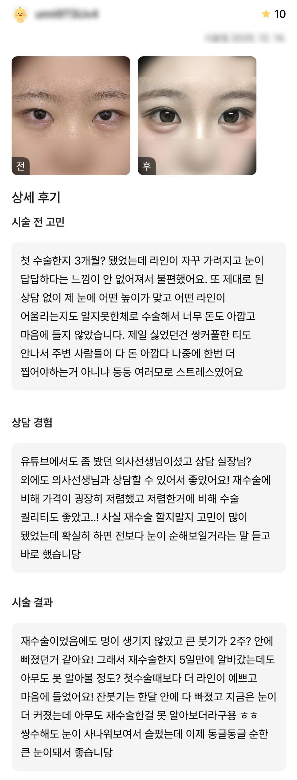 디엠 눈재수술 후기, “첫 수술 때보다 라인이 더 예쁘고 마음에 들었어요!” 관련 이미지 1