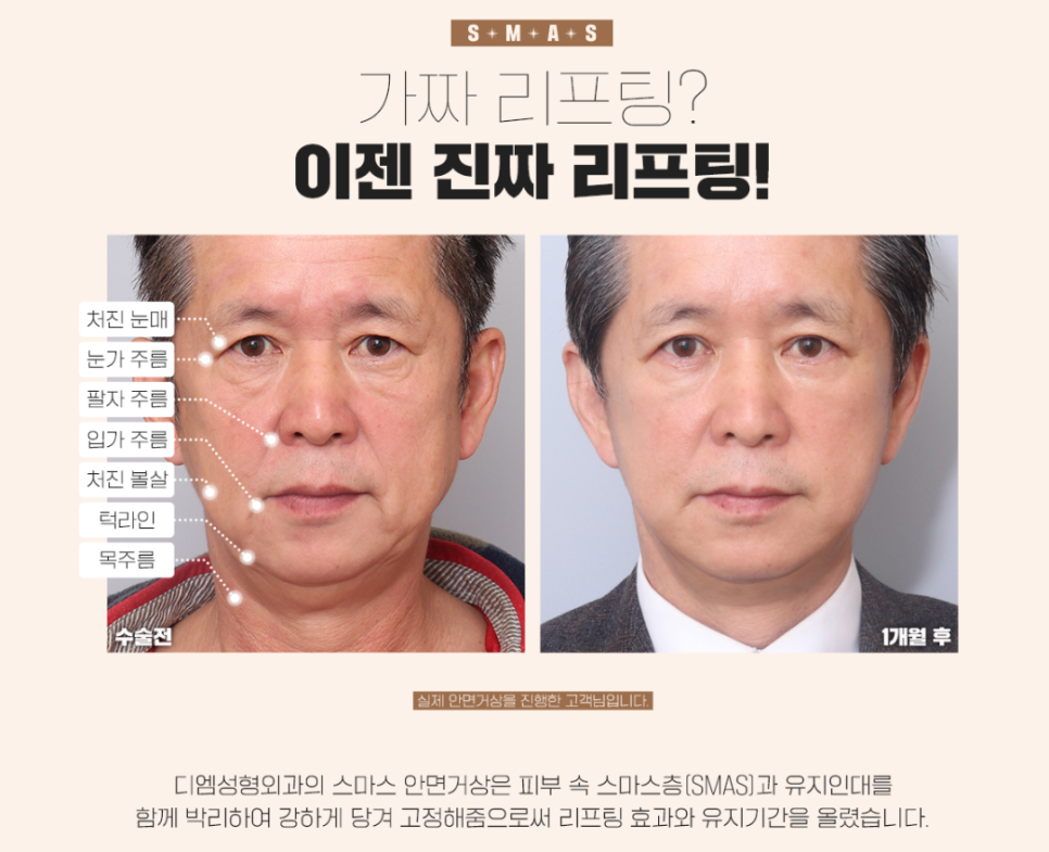 안면거상, 개인별 맞춤형 플랜으로 더욱 높아진 만족도! 관련 이미지 4
