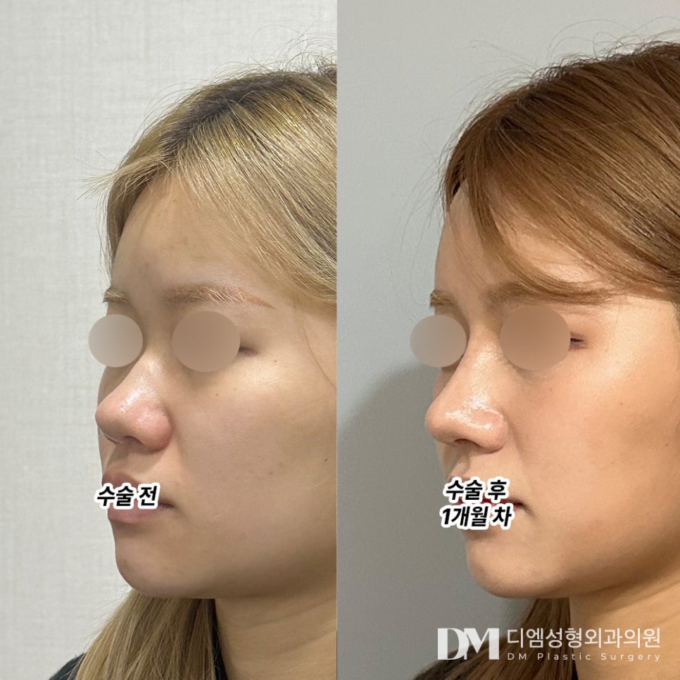 코성형 후기."너무 만족이 커서 극극 추천입니다 !" 관련 이미지 2