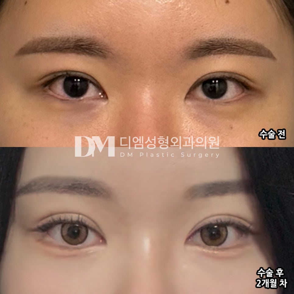 눈재수술 후기."주변에서 이목구비가 더 또렷해졌대요!" 관련 이미지 2