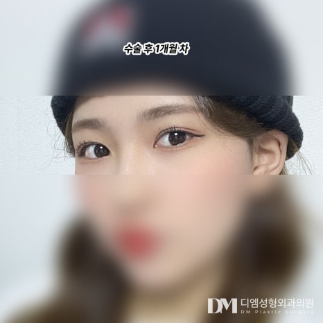 눈성형 후기."너무 자연스럽게 잘 됐어요!" 관련 이미지 3