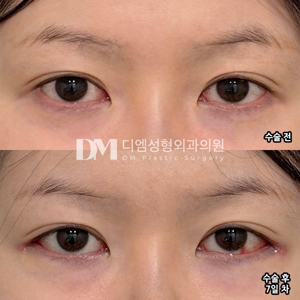 디엠 뒤밑트임 수술후기, “예상보다 더 잘 나와서 매우 만족합니다!” 관련 이미지 2