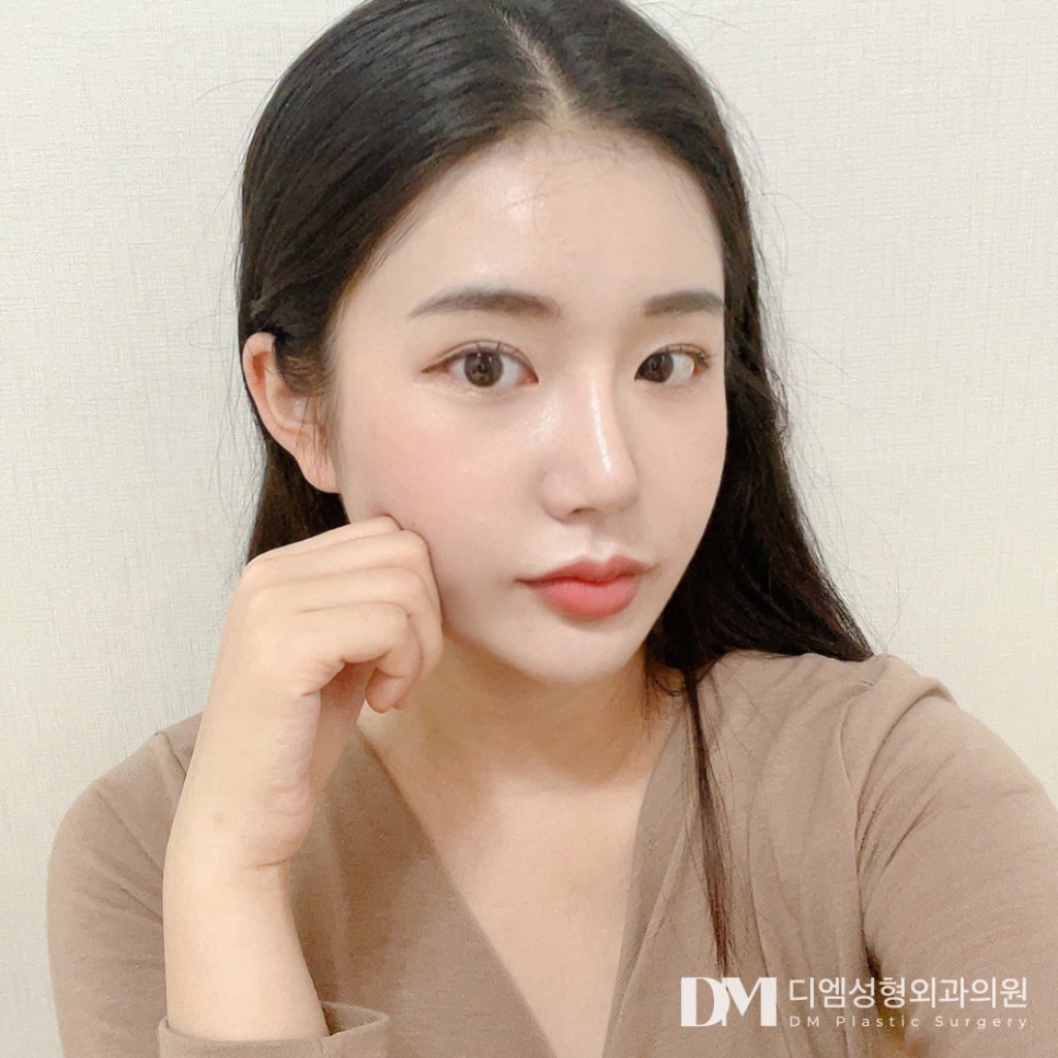 눈밑지방재배치, 피곤한 인상 볼록한 눈밑 개선 효과! 관련 이미지 11
