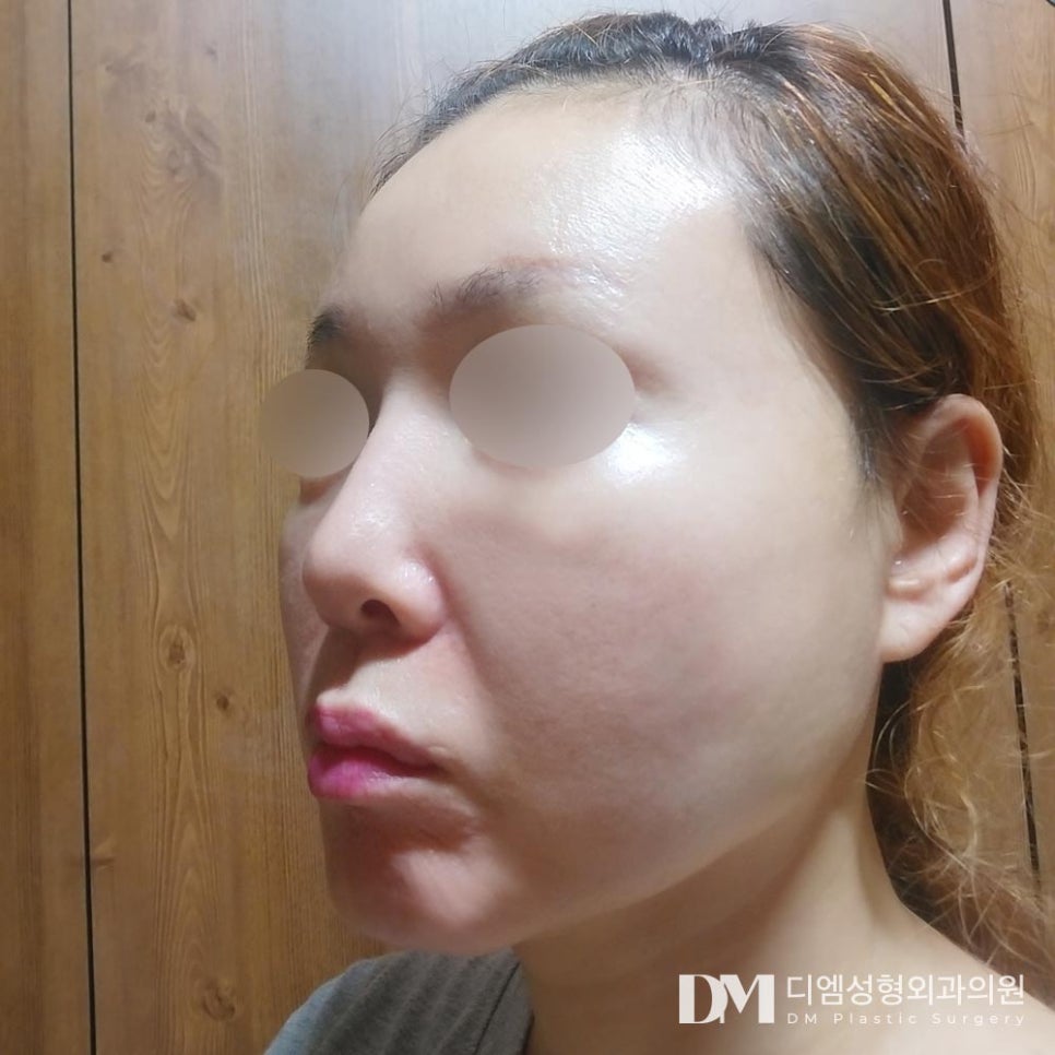 반거상, 중안면부의 처짐과 팔자,입꼬리 주름 개선에 최고! 관련 이미지 8