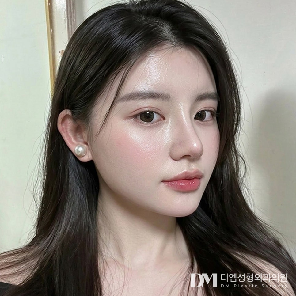 디엠 복코성형 후기사진, 뚱뚱한 코끝 슬림하게 만드는 비결은? 관련 이미지 1