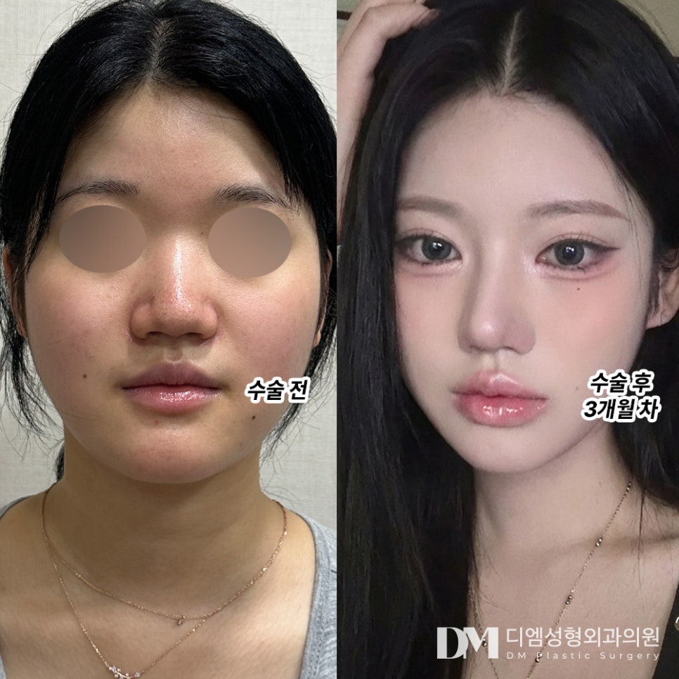Nose Revision Surgery Review. "I got a really naturally pretty nose!" image 2