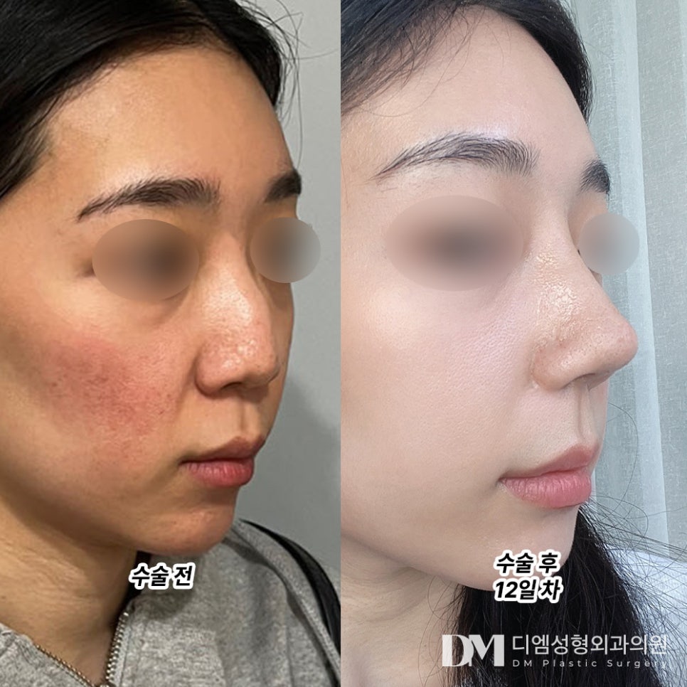 코재수술 후기."근래 한 시술 및 성형 중 가장 만족스럽습니다!" 관련 이미지 2