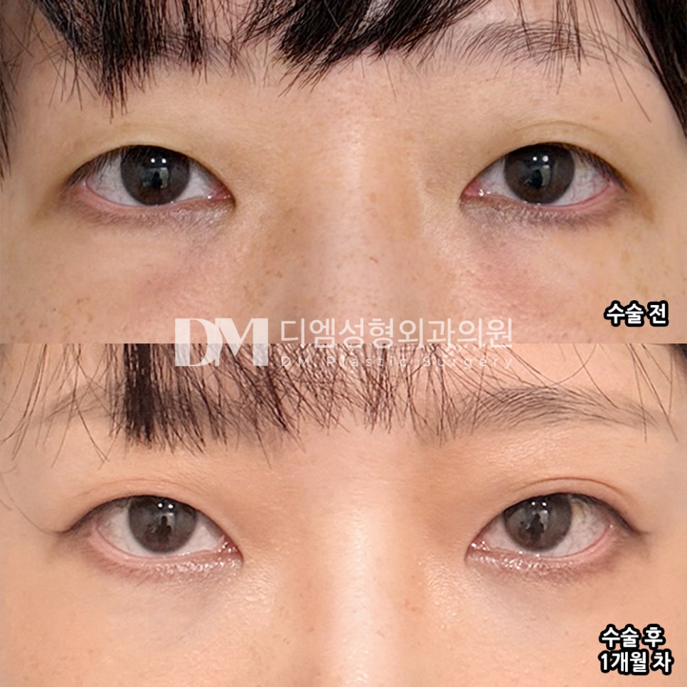 디엠 눈밑지방재배치 수술후기, &ldquo;피곤해 보이던 인상이 환해졌어요!&rdquo; 관련 이미지 2