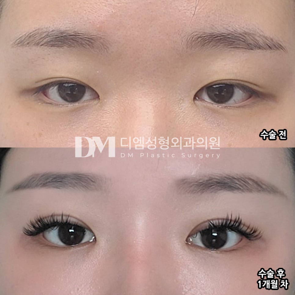 눈매교정, 졸려보이는 눈을 또렷하게 ! 관련 이미지 12