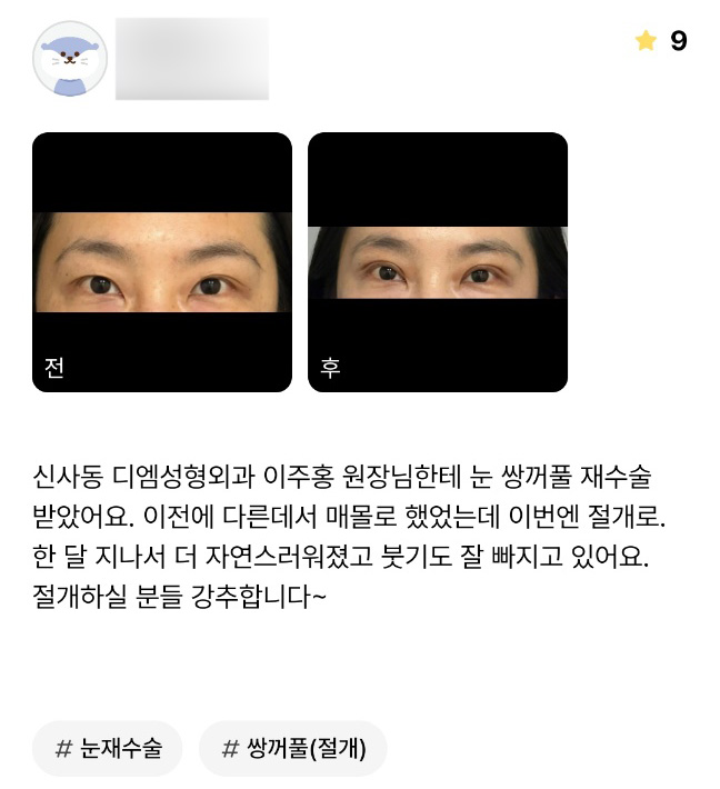 눈재수술 후기."절개하실 분들 강추합니다 ~" 관련 이미지 1