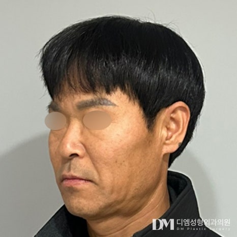 Facelift + Rhinoplasty Review: “Seeing the improvements comforted me after all the time I spent worrying!” image 2
