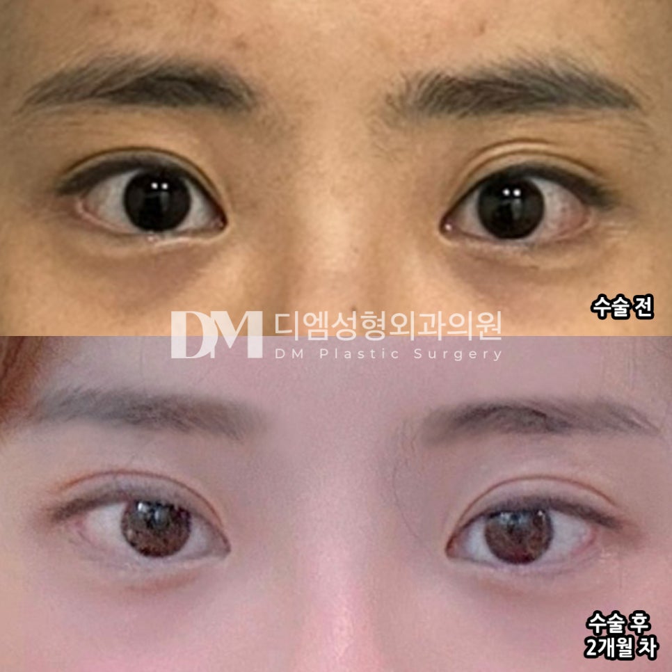 눈재수술 후기."완전 제 눈처럼 됐어요!" 관련 이미지 2
