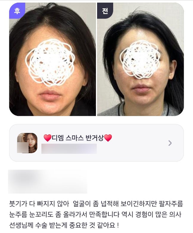 Mini Facelift Review: “It really seems important to have the procedure performed by a doctor with extensive experience!” image 1