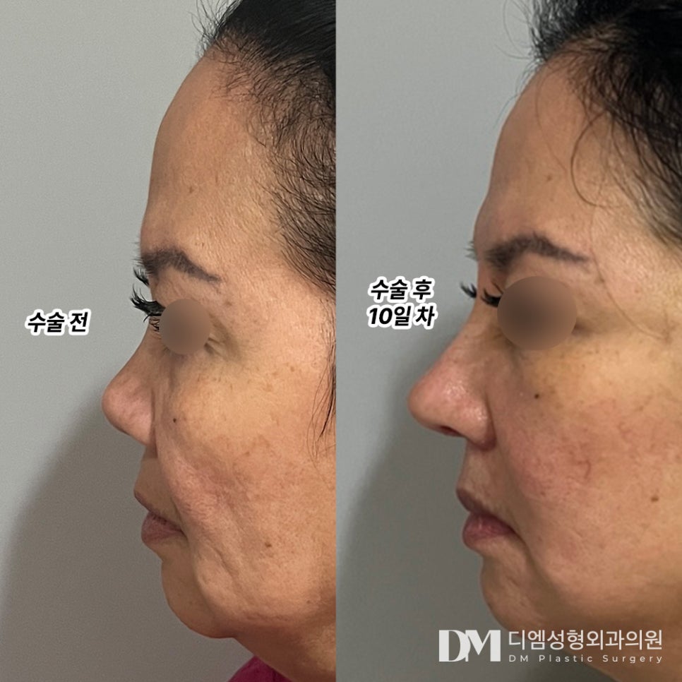 짧은코성형 하나만으로도 입체적인 얼굴로 ! 관련 이미지 8