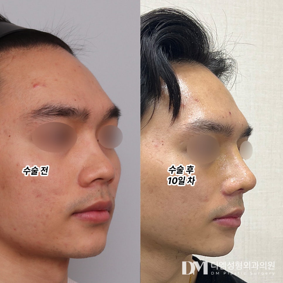 짧은코 성형, 얼굴 비율과 인상 동시 개선하기 ! 관련 이미지 8
