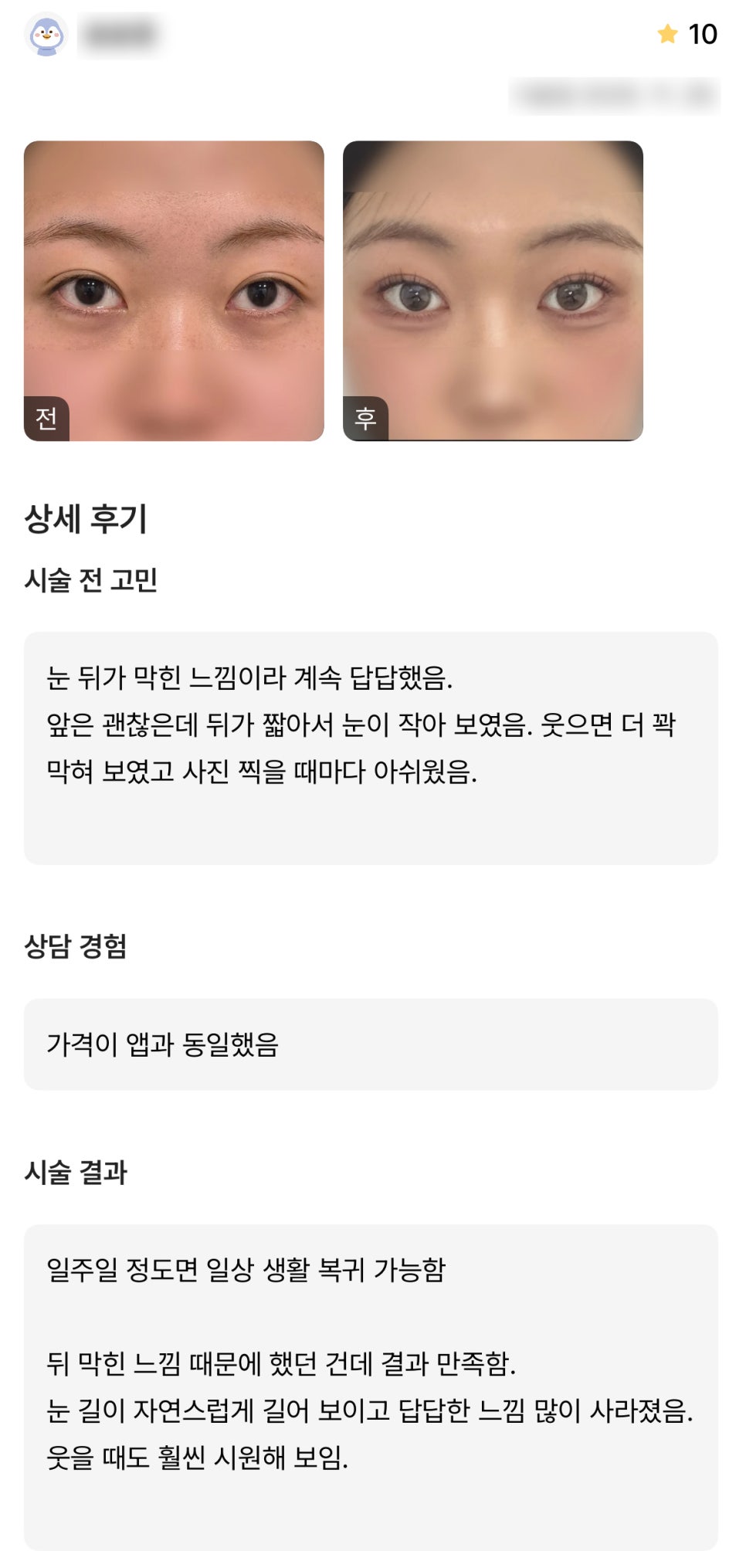 디엠 뒤밑트임 수술후기, “눈 자연스럽게 길어 보이고 답답한 느낌이 많이 사라졌어요!” 관련 이미지 1