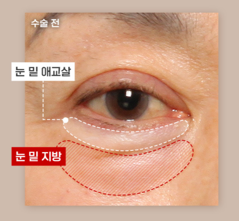 하안검, 눈 밑 노화가 고민이라면? 관련 이미지 3