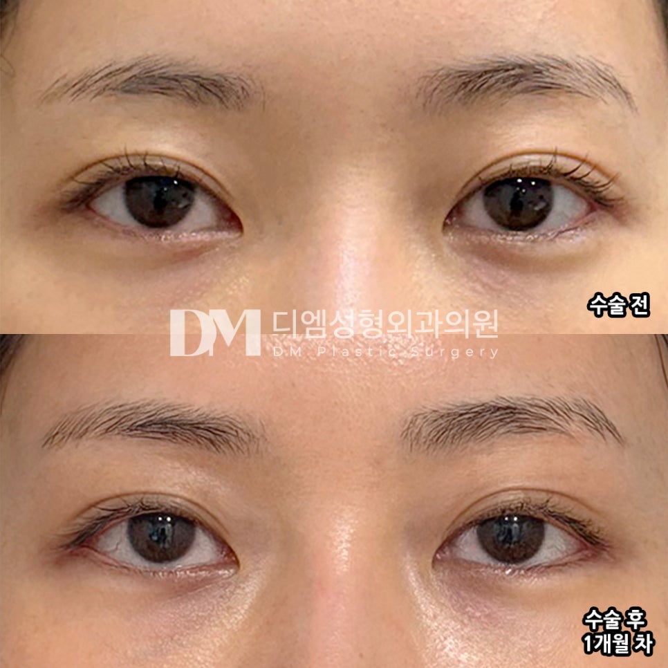 디엠 뒤밑트임 수술후기, “눈이 확실히 내려가 보여요!” 관련 이미지 2