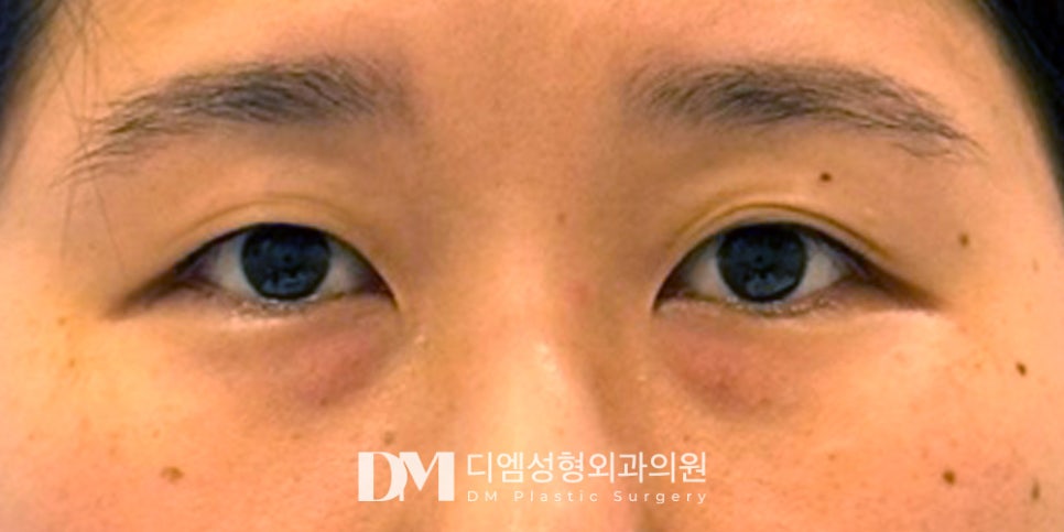 눈밑지방재배치 ,울룩불룩하고 칙칙한 눈밑이 고민이라면? 관련 이미지 6