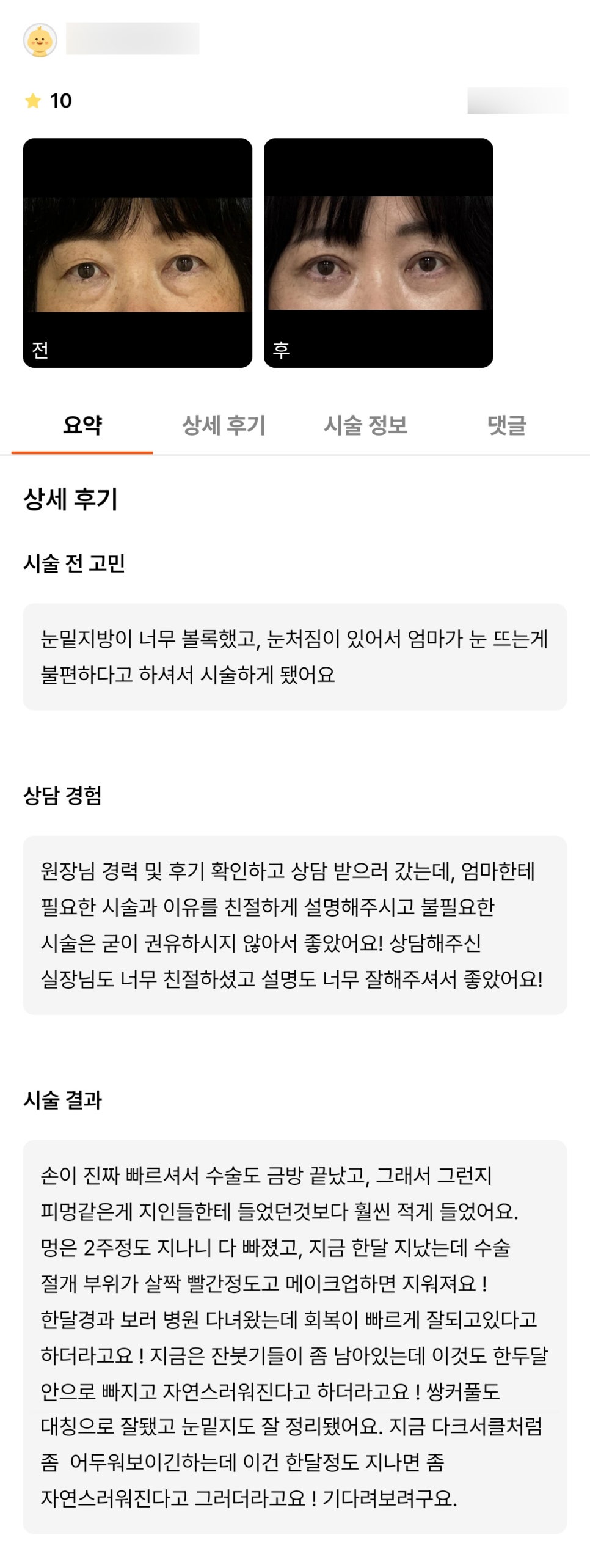 눈성형 후기."자연스레 잘 정리되어 좋아요!" 관련 이미지 1