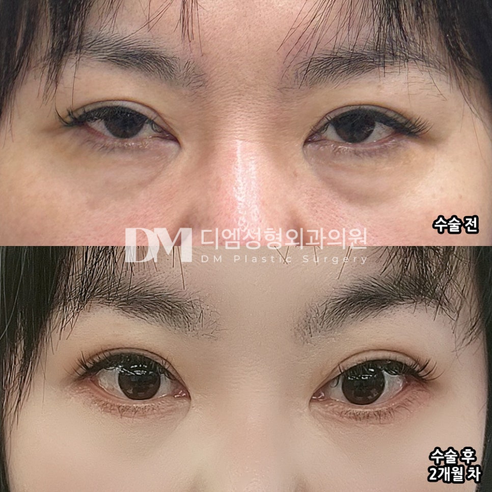 Lower Blepharoplasty Review. “I’ll recommend it to everyone, and if I need another procedure, I’ll come here for a consultation!” image 2